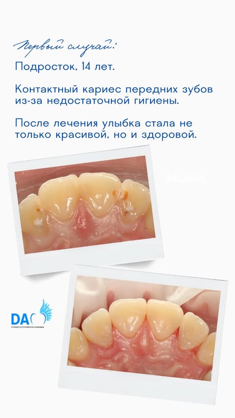 Лечение кариеса и реставрация