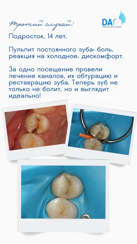 Кейс: лечение пульпита — реставрация зуба