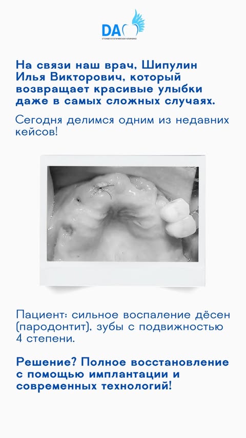 All-on-4 — полное протезирование