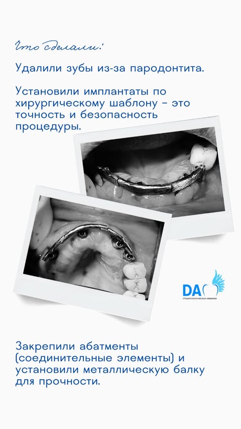 Кейс: установка имплантатов по хирургическому шаблону