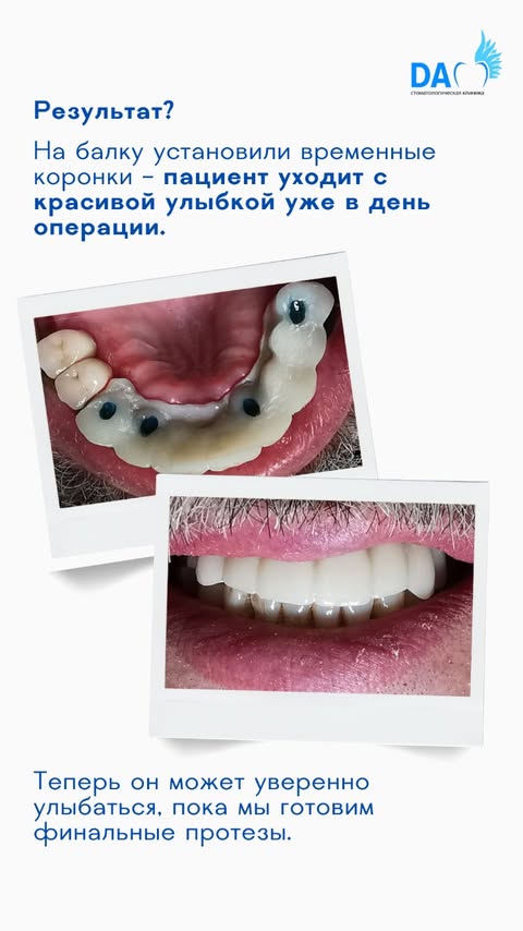 Кейс: результат — красивая улыбка после протезирования
