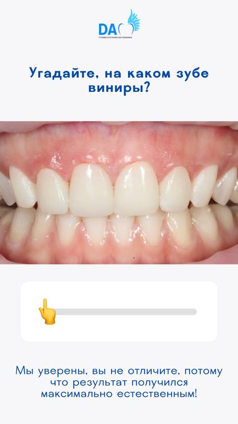 Кейс: этапы протезирования