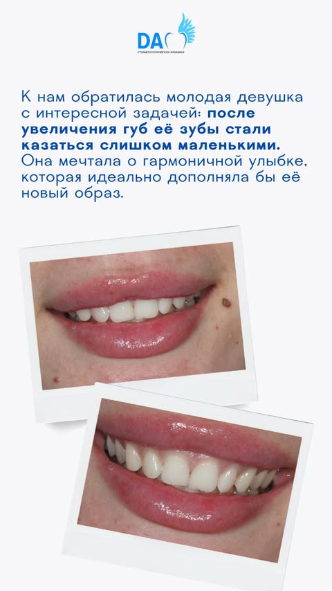 Кейс: сложный случай реставрации